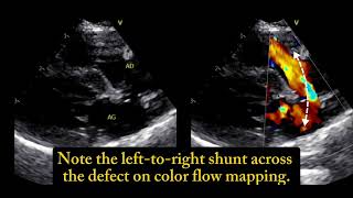 Ostium secundum atrial septal defect a 6 monthold cat 🐱 [upl. by Auohp]