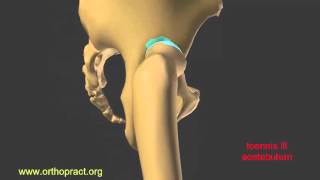 hip dysplasia luxation pseudo acetabulum [upl. by Eatnuahc651]