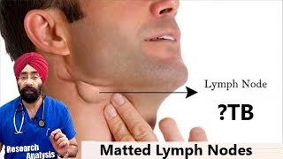 Matted Lymph Nodes क्या होता है  Lymphadenopathy  TB  DrEducation Hindi [upl. by Corbin]