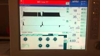 Introduction to APRV Part 2 [upl. by Edana728]