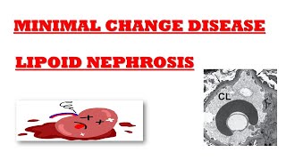 Minimal Change Disease  Nephrotic Syndrome  Lipoid Nephrosis  Simplified Explanation [upl. by Sirahc]