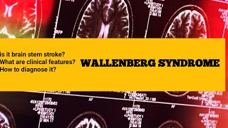 wallenberg syndrome  wallenberg syndrome mnemonic [upl. by Amin]