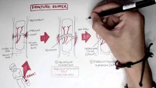 Bone Fracture  Types Fracture Repair and Osteomyelitis [upl. by Mullins]