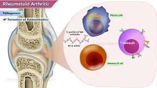 Rheumatoid Arthritis  Etiology  Pathogenesis  Clinical features  Diagnosis and Treatment [upl. by Neirb367]