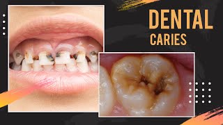 Dental caries  Oral Pathology  ppt share dentalcaries healthysmile [upl. by Garda]