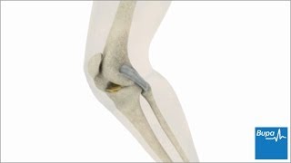 How knee arthroscopy is carried out  Bupa Health [upl. by Nyrad]