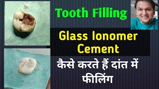 Tooth Filling Glass Ionomer Cement  GIC Restoration  GIC filling [upl. by Abil518]