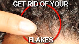 Why your scalp is flaky and HOW to FIX it [upl. by Dianuj]