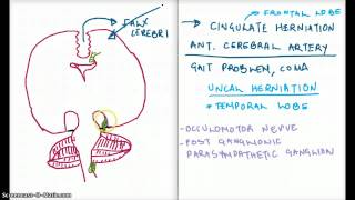 Easy Ways to Remember Cerebral Herniation [upl. by Oretna]