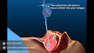 Sleep Apnea Treatment by Aspire Medical Device [upl. by Avictor]