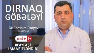 Dirnaq gobeleyi xesteliyi  Dırnaq göbələyi  Dermatoloq İbrahim Rzayev  MEDPLUS I3 [upl. by Ridglea602]