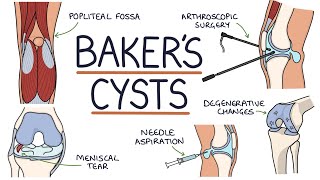 Understanding Bakers Cysts Popliteal Cysts [upl. by Anidene]