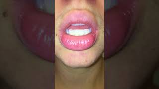 exfoliative cheilitis  day 0 pre treatment  tacrolimus amp burts bees wax hand salve [upl. by Mcgrath]