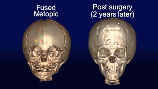 Metopic Synostosis [upl. by Larimer417]