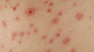 DermTV  How to Remove Chickenpox Scars DermTVcom Epi 382 [upl. by Kreegar]