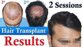 Hair Transplant with low Donor Dr Suneet Soni  Medispa India  Best Hair Transplant Jaipur Delhi [upl. by Adnir]