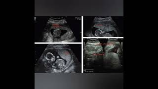 Placental Maturation with Example gynae pregnancy ultrasound medical health trending [upl. by Vescuso]