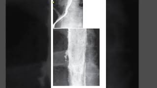 Differential diagnosis of Esophageal ulcers shorts [upl. by Eimaraj]