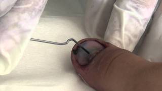 Trephining a nail to drain subungual haematoma [upl. by Gettings]