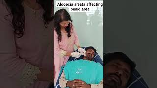 Alopecia areata affecting beard area [upl. by Hcra]