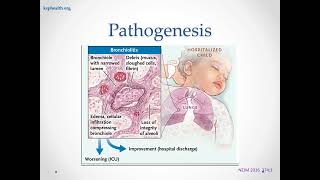 Bronchiolitis 8 31 24 [upl. by Aniras230]