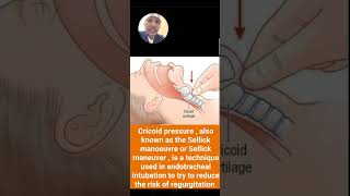 cricoid pressure 3kg30Nsellick maneuver Tamil anesthesia technology intubation RSI Aspiration [upl. by Jillayne]