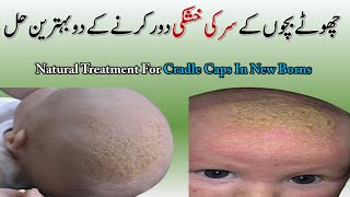 Bacchon Ke Sar Ki Khushki Ka Ilaj  New Born Head Skin Peeling  Baby Head Skin Peeling  Cradle Cap [upl. by Ysle943]