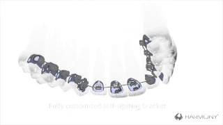 American Orthodontics Harmony Self Ligating Digital Lingual System Aparelho Lingual [upl. by Hinson450]