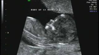 12 weeks 1 day Ultrasound [upl. by Lancelot]