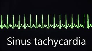 Sinus rhythm bradycardia and tachycardia [upl. by Nylecsoj]