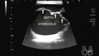 Ultrasound Video showing a large Epididymal cyst with hydrocelepyocele [upl. by Louisette]