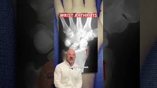 Wrist Arthritis Pain Fusion Relief shorts [upl. by Rosati]