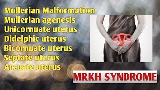 Mullerian Malformation Mullerian Duct Anomalies Mullerian Agenesis or MRKH SyndromeUnicornuate [upl. by Snell296]