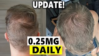 Finasteride Microdosing Update 2022 [upl. by Huttan720]