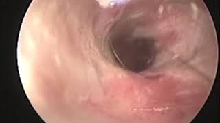 Pseudomonas Otitis resolved in 16 days [upl. by Adnovaj]