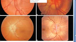 Ophthalmology Papillodema stages Paton line champagne cork dome corpora amylacea drusen vintage [upl. by Osnofla]