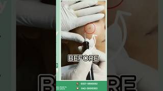 Electrocautery for Viral Warts Quick amp Effective Wart Removal enhancebydrwajieha [upl. by Kolk]