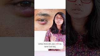 চোখের পাতায় অঞ্জনি হলে করণীয় [upl. by Lubbock]