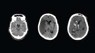 How to Read a CT Scan of the Head  MEDZCOOL [upl. by Coraline]