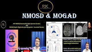 By Dr Ramesh Krishnan Neurologistnmosd diseaseoptic neuritismogad diseasemultiple sclerosis [upl. by Rehpinej]