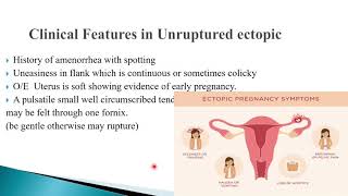 Ectopic pregnancy [upl. by Talich]