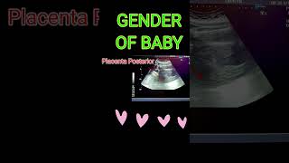 BABY GENDER VS PLACENTA shortsfeedpregnancy [upl. by Aizahs]