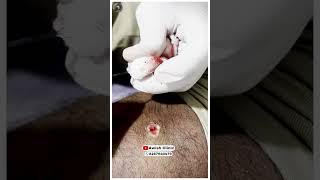 Get Rid of Warts Quickly and Easily Easy and PainlessAWISH Clinic [upl. by Ilram]