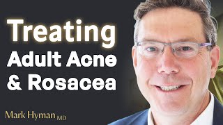 Treating Adult Acne amp Rosacea From The Inside Out [upl. by Melone]