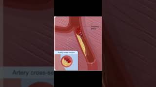 O que é o infarto do miocárdio anatomy fisiologia medstudent fisiopatologia biologia fisio [upl. by Jeniece120]