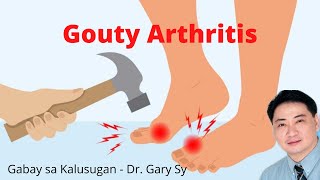 Gouty Arthritis  Dr Gary Sy [upl. by Wilmar146]