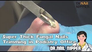 Super Thick Fungal Nails Trimming in Podiatry Office [upl. by Yasu]