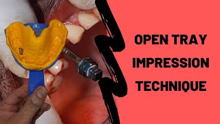 How To Take an Open Tray Implant Impression DEMO [upl. by Aloise]