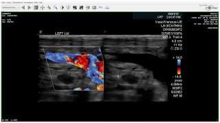 Positive Upper Extremity Venous Duplex  Case Study [upl. by Belicia]