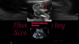 19weeks baby boy scrotum development shortsfeed pregnancy ultrasound [upl. by Kerek634]